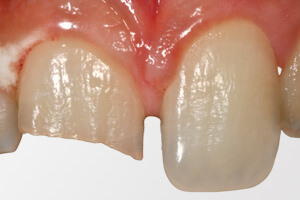 Механическое повреждение зуба