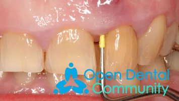 Лечение флюса во рту на десне в стоматологии