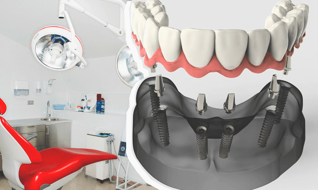 Метод имплантации зубов – Resmile