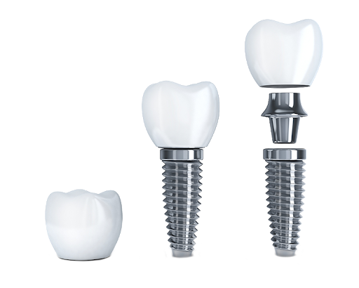 Стоимость установки имплантатов зубов