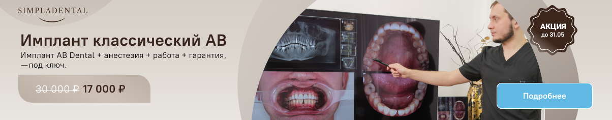Имплант классический AB Dental