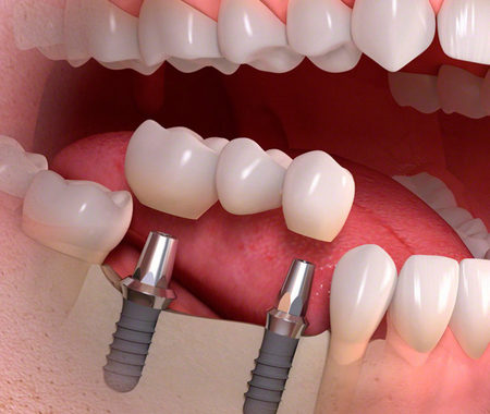 Однофазная имплантация зубов