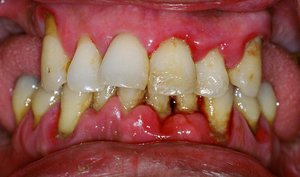 Пародонтит в стоматологии
