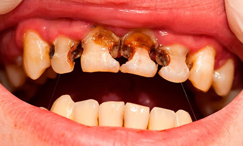 от каких наркотиков выпадают зубы