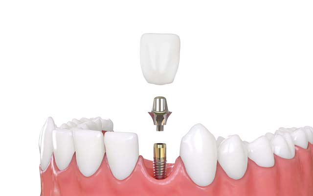 Акции на установку имплантатов зубов