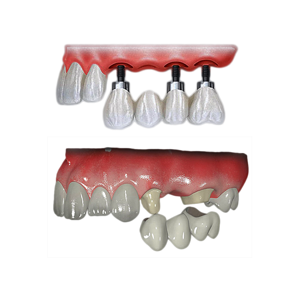 Имплантация или протезирование зубов