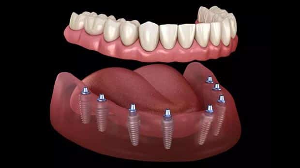 Имплантация зубов All on 8