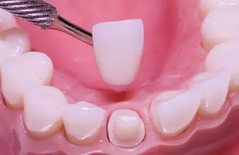 Зубные коронки: основные разновидности