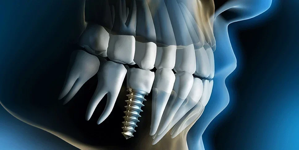 картинка Имплантация зубов