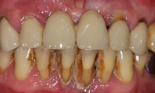 Профилактика проблем с зубами под коронками