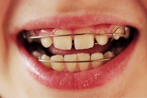 применение пластин с целью корректирования зубов