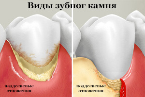 Виды зубных камней