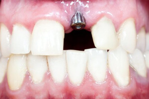 Имплантация верхних передних зубов
