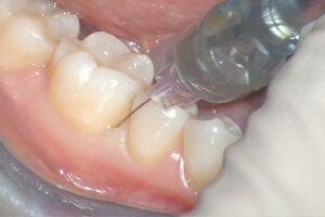 Внутрисвязочная анестезия в стоматологии 