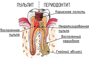 Лечение с гной зуб thumbnail