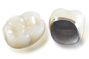 Металлокерамические зубные протезы