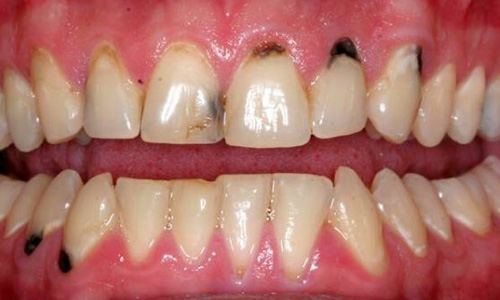 При надавливании зуб под коронкой начинает болеть