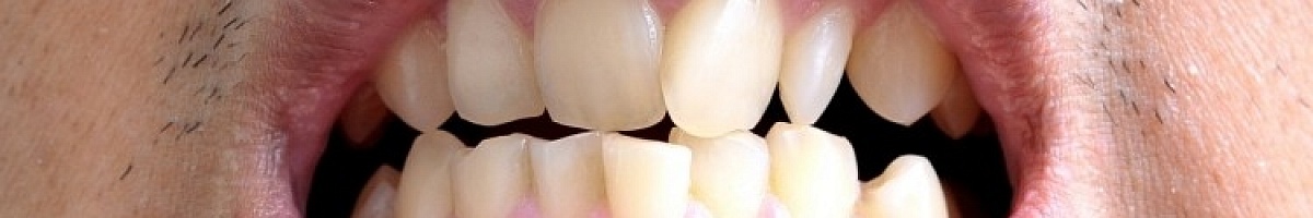 Что делать если кривые зубы?