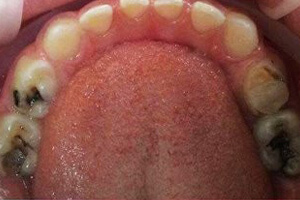 Болит зуб под коронкой или мостом: что делать?