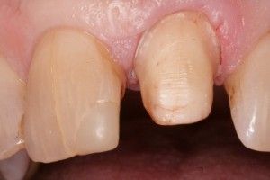 Симптоматика треснувших зубов