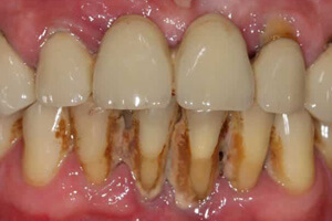 Возрастное потемнение зубов